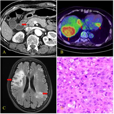 Case Report: Acute cerebral infarction as the initial manifestation of malignant tumors with trousseau syndrome in the elderly